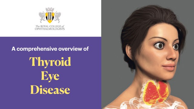A comprehensive overview of thyroid eye disease